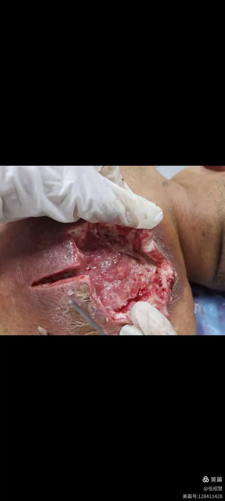 1例2型糖尿病并背部巨大痈